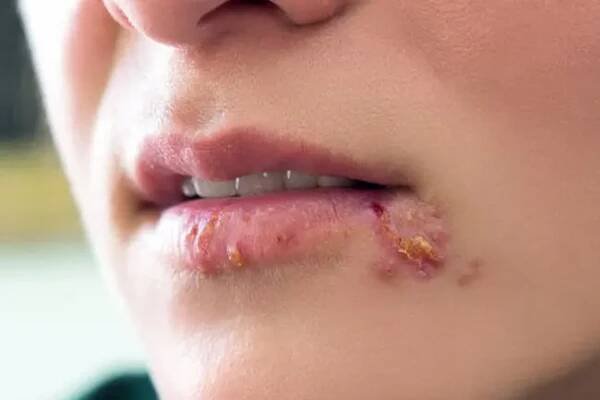 What Do Herpes Sores Look Like at Different Stages?