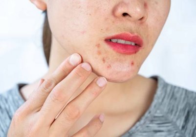Sebaceous hyperplasia causes yellowish or flesh-coloured bumps on the skin, which normally occur on the face and are shiny