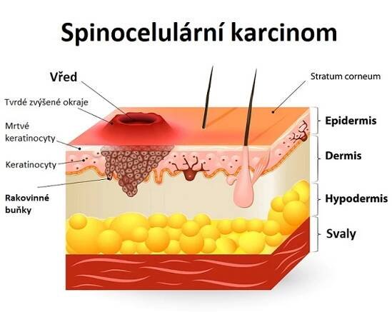 Spinocelulární karcinom (spinaliom, dlaždicobuněčný karcinom) - ilustrace