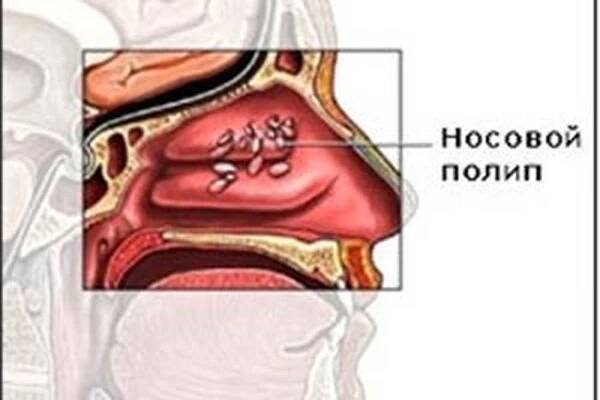 Co jsou nebezpečné polypy v nosu? Symptomy, léčba a odstranění / Polypy