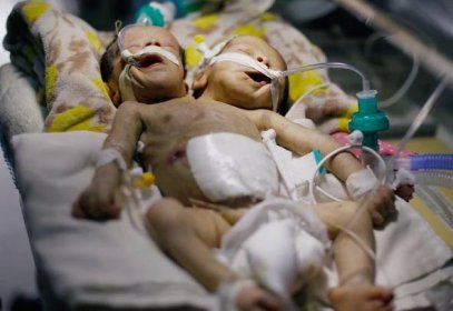Doma zemřou. Lékaři z Jemenu zmítaného bídou a válkou hledají pomoc pro siamská dvojčata