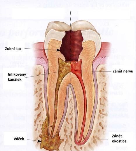 Ošetření kořenových kanálků :: Duostoma