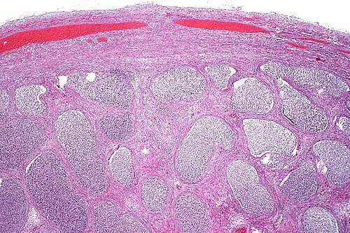Epididymitis - Wikipedia