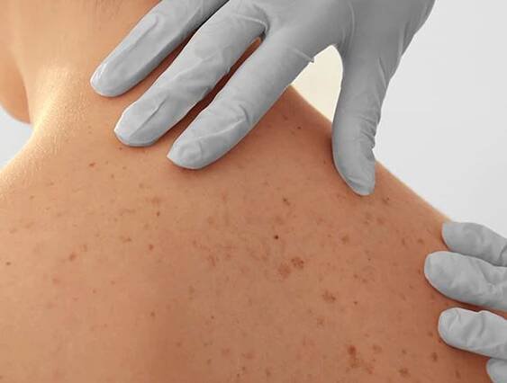Kentucky Skin Cancer Center – Skin Cancer Screening Specialist