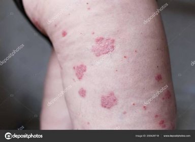 Alergická vyrážka dermatitida kůže ekzém na noze pacienta. Lupénka a ekzémy kůže s velkými červenými skvrnami. Koncepce zdraví