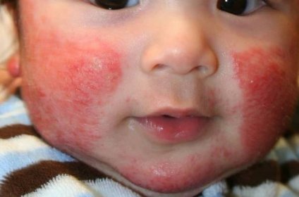 Jak vypadá alergická vyrážka u dětí (27 fotografií): různé vyrážky v případě alergie na kůži, vysvětlení toho, jak vypadá