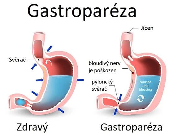 Gastroparéza - ilustrace