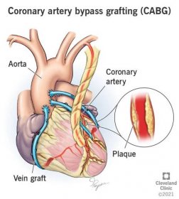 Operace bypassu srdce - co to je a kdy se vyplatí operaci bypassu podstoupit?