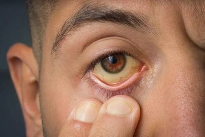 Nemocný muž kontroluje žluté oči kvůli vysoké hladině bilirubinu, cirhóze nebo hepatitidě. Onemocnění jater, problémy s játry nebo žloutenka — Stock obrázek