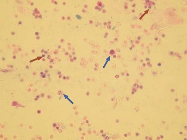 Leukocyty | Mikroskopické vyšetření moče | Lékařská fakulta Masarykovy univerzity