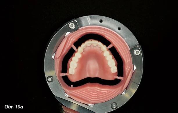 Digitálně zhotovená imediátní celková snímatelná náhrada | StomaTeam, s.r.o. - Váš průvodce dentálním světem