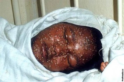 WHO prošetřuje, zda se v Ugandě opravdu objevily pravé neštovice