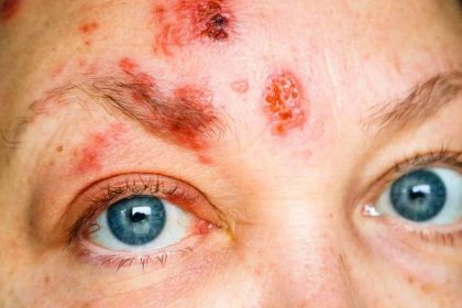 pásový opar na obličeji a kolem oka, zvané oftalmologické herpes zoster nebo herpes zoster oftalmáš - pásový opar nemoc - stock snímky, obrázky a fotky