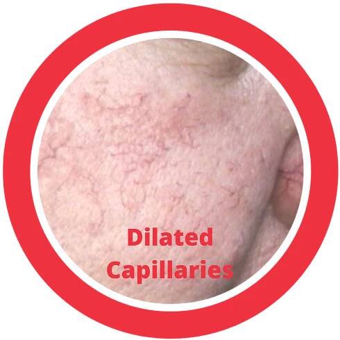 Dilated Capillaries