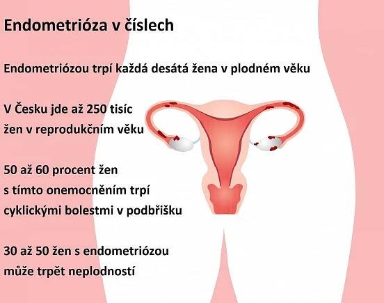 Potíže, které dříve znamenaly neplodnost, umí lékaři vyřešit miniinvazivní operací