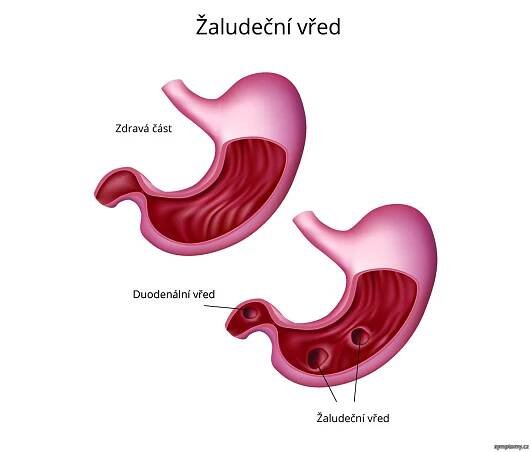 Žaludeční vřed