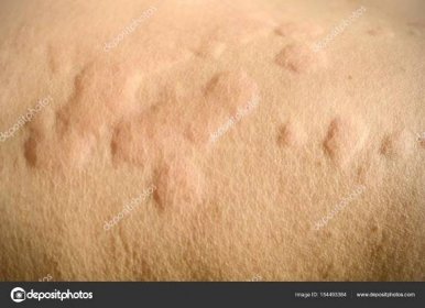 Kožní vyrážka, kopřivka, alergická reakce pokožky. — Stock Fotografie © areeya #154493384