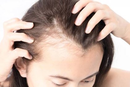 Nemoci a vypadávání vlasů