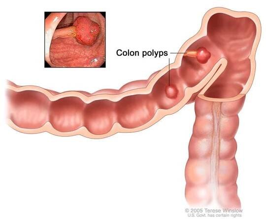 Ako môže pomôcť NaturalHelp Complex proti vzniku polypov v hrubom čreve?