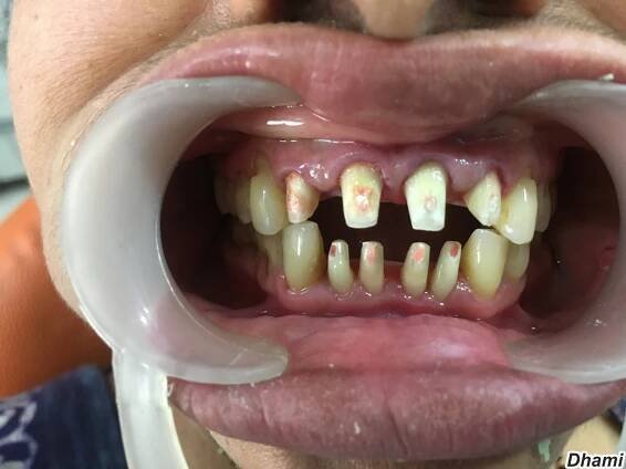 Composite & anterior smile design | Dhami Dental Clinic | Surat