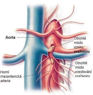 jak-se-projevuje-tromboza-mezentericke-arterie-priznaky-projevy-symptomy