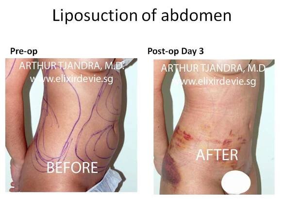 Liposuction Case Studies by Dr Arthur Tjandra of L’Élixir de Vie