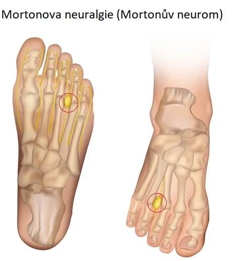Mortonova neuralgie (Mortonův neurom) – co je to – příznaky, příčiny a léčba