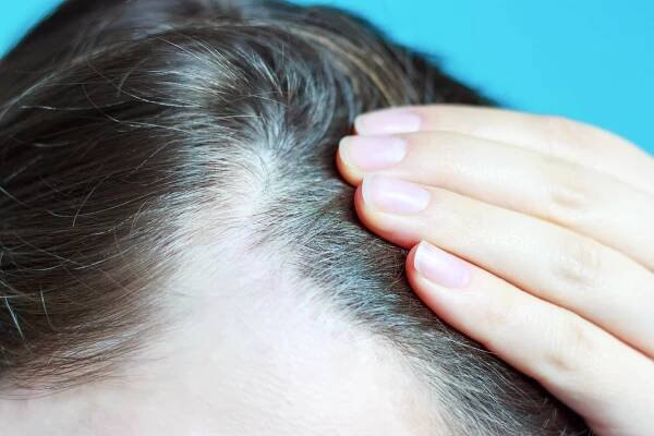 Boob job made me go bald - I wanted a new bust after I had a baby but then hair came out in clumps…I even lost eyelashes