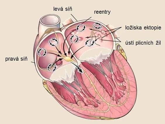 Mechanismus vzniku fibrilace síní