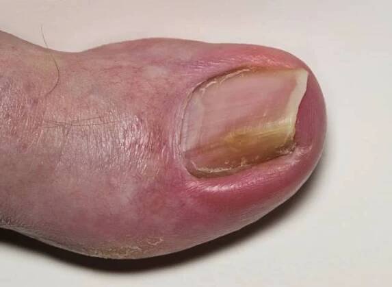 zarostlá nehtová onychocryptóza na kavkazské velké patě hallux. - zarostlý nehet - stock snímky, obrázky a fotky
