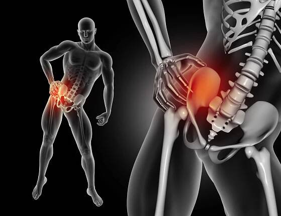 Femoroacetabulární impingement (FAI) – příčiny, příznaky a léčba