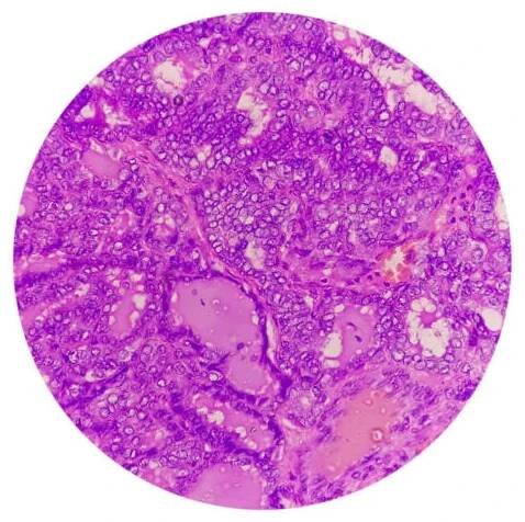 metastazující papilární karcinom štítné žlázy (rakovina), centrální lymfatická uzlina. - axillary lymph node - stock snímky, obrázky a fotky