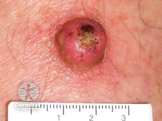 Keratoacanthoma: A Complete Overview with Images - DermNet