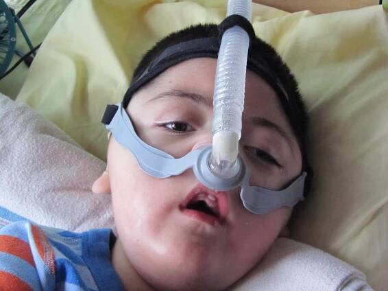 Spinální svalová atrofie SMA - příznaky, projevy, symptomy - Příznaky a projevy nemocí