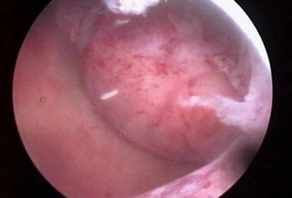 Treatment: Surgery