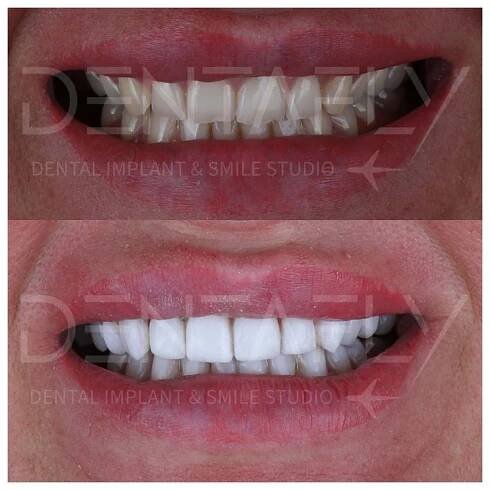 composite-bonding-before-after-6