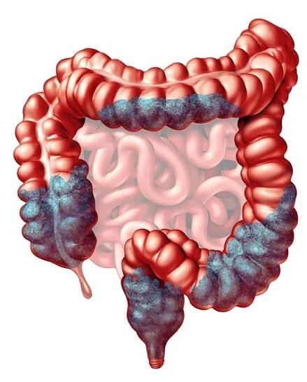 Zácpa anatomie a zácpa příznaky jako stolice střeva pohybový problém jako střeva a konečníku trávicího ústrojí jako gastrointestinální lékařský symbol izolovaný na bílé jako 3D ilustrace. — Stock obrázek
