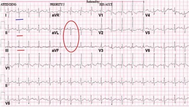 Levý zadní hemiblok - EKG | Medicína, nemoci, studium na 1. LF UK
