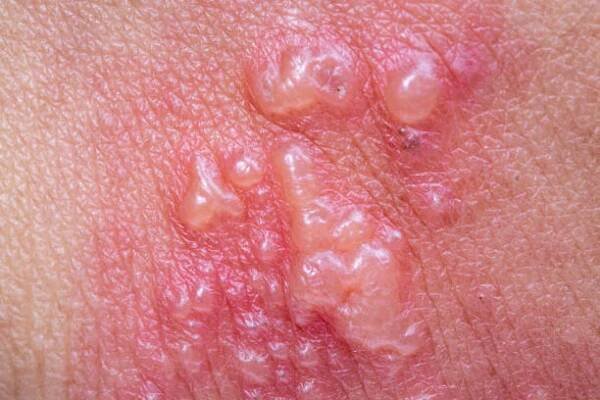 příznaky pásových oparů, zoster nebo herpes zoster na paži - ganglion - stock snímky, obrázky a fotky