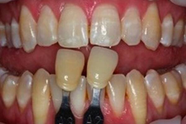 Seeing is Believing - Amazing KöR Whitening Results