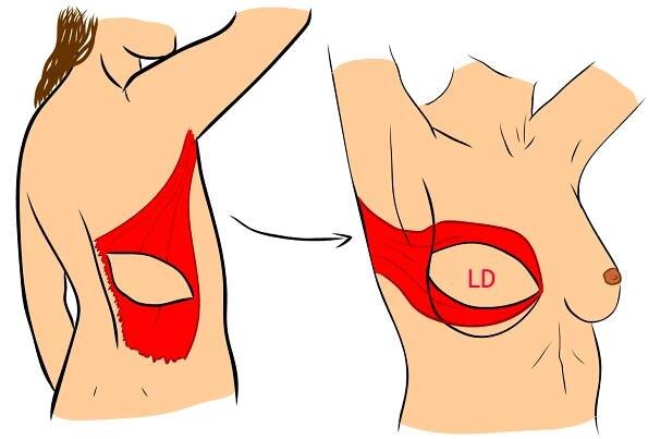 Rekonstrukce lalokem m. latissimus dorsi