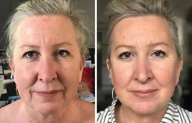 Neinvazivní facelifting obličeje i zpevnění těla