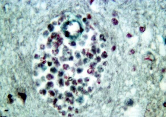 Záhadná epidemie "mozkožrouta": V 60. letech zemřelo 16 lidí, jen si šli zaplavat