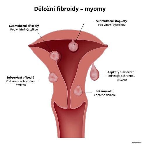 Děložní fibroidy---myomy