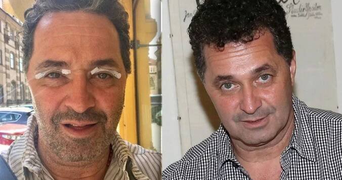 Martin Dejdar mění tvář i ve skutečnosti: Navštívil plastického chirurga!