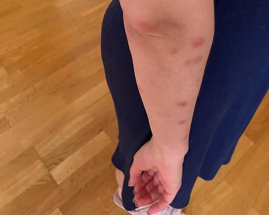 Jak rozeznat štípance od štěnic – Derona