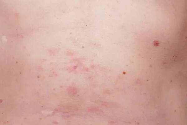 Kožní vyrážka léčba na těle ženy. pásový opar, choroba, herpes zoster, virus varicella-zoster. kožní vyrážka a puchýře na těle. Pozadí — Stock obrázek