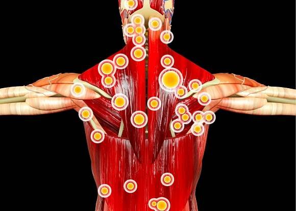 Troublesome Trigger Points
