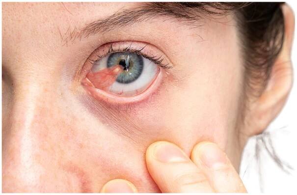 Pterygium
