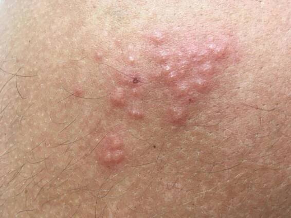 Herpes simplex | Dermaweb